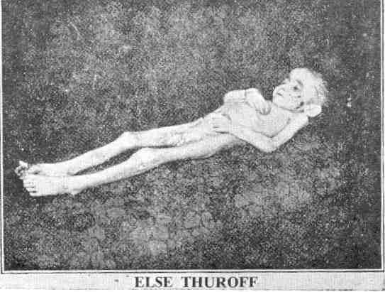 Elsie Thuroff 1920. március 3-án született, és 1921. június 8-án oltották be. Ugyanezen év augusztusában "heves csikorgó fájdalmaktól, valamint a karja csontjainak duzzanatától és torzulásától kezdett szenvedni egészen a válláig. Az orvosi diagnózis a csontok tuberkulózisa volt. Műtéten esett át, ami után az állapota folyamatosan rosszabbodott, míg a karja felhúzódott és tehetetlen lett. Az arcbőre leégett. Az oltásnyomok elgennyesedtek, és a test élő csontvázzá sorvadt. "Kínzó fájdalmak után 1923. január 8-án halt meg."